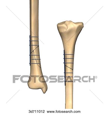 Stabilization of transverse or short oblique and short butterfly fractures by direct fixation with plates and screws. View Large Illustration Drawing - Stabilization of transverse or short oblique and short butterfly fractures by direct fixation with plates and screws.. Fotosearch