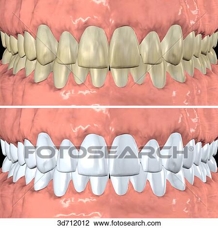 The bleaching of teeth for esthetic reasons. View Large Illustration Drawing - The bleaching of teeth for esthetic reasons.. Fotosearch