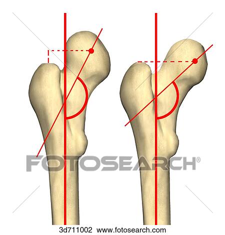 Varying configurations of the angle of the hip joint wheren the greater trochanter is abnormally low. View Large Illustration Drawing - Varying configurations of the angle of the hip joint wheren the greater trochanter is abnormally low.. Fotosearch