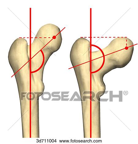 Stock Illustration - Varying configurations of the angle of the hip joint where the greater trochanter is abnormally high.. Fotosearch