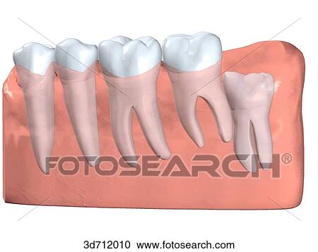 Vertical impacted third molar. View Large Illustration Clipart - Vertical impacted third molar.. Fotosearch