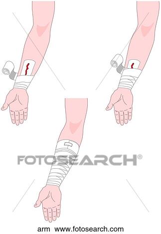 Bandaging Arm Wrap View Large Illustration Stock Illustration - Bandaging Arm Wrap. Fotosearch