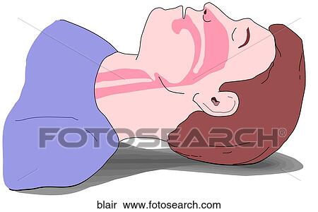 Stock Illustration - Blocked Airway. Fotosearch