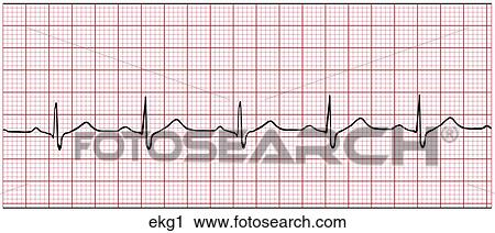 EKG-Normal View Large Illustration Clip Art - EKG-Normal. Fotosearch