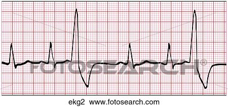 EKG-Premature V. Contrac. View Large Illustration Drawing - EKG-Premature V. Contrac.. Fotosearch