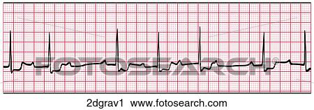 2nd Degree AV Block Type 1 View Large Illustration Clip Art - 2nd Degree AV Block Type 1. Fotosearch