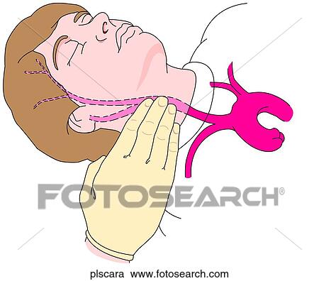 Clipart - Carotid Pulse in Adult. Fotosearch