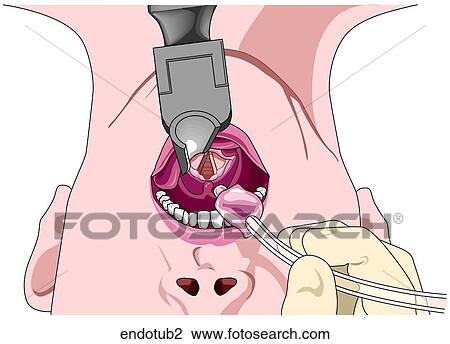 Endotracheal Intubation-Intubating View Large Illustration Drawing - Endotracheal Intubation-Intubating. Fotosearch