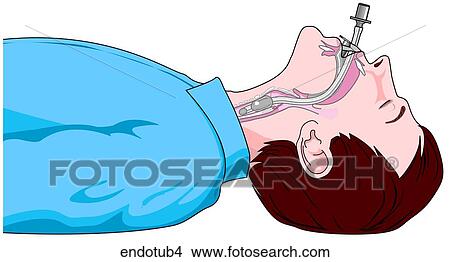Endotracheal Intubation-Tube in Place View Large Illustration Stock Illustration - Endotracheal Intubation-Tube in Place. Fotosearch