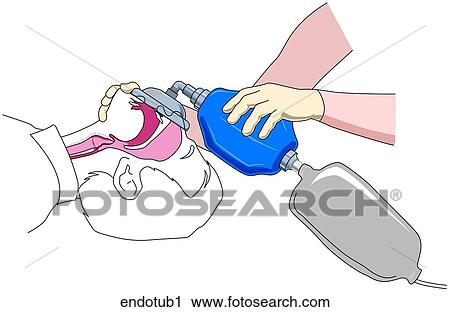 Endotracheal Intubation-Ventilation View Large Illustration Clip Art - Endotracheal Intubation-Ventilation. Fotosearch