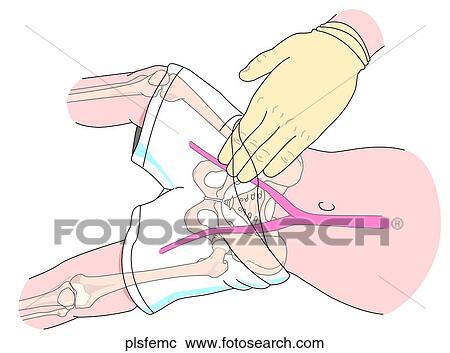 Femoral Pulse in Child View Large Illustration Clipart - Femoral Pulse in Child. Fotosearch