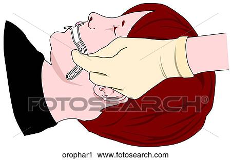 Oropharyngeal Airway 1-Measuring Airway View Large Illustration Clip Art - Oropharyngeal Airway 1-Measuring Airway. Fotosearch