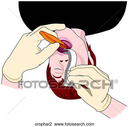 Drawing - Oropharyngeal Airway 2-Inserting Airway. Fotosearch