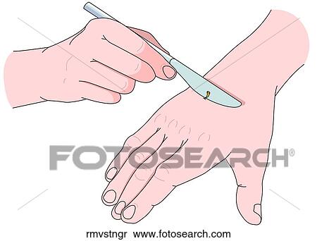 Removing Stinger View Large Illustration Stock Illustration - Removing Stinger. Fotosearch