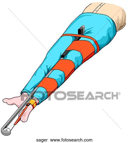 Sager Splint View Large Illustration Stock Illustration - Sager Splint. Fotosearch
