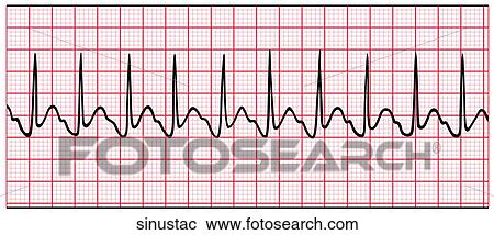 Sinus Tachycardia View Large Illustration Clipart - Sinus Tachycardia. Fotosearch