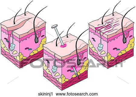 Clip Art - Skin Injuries 1. Fotosearch