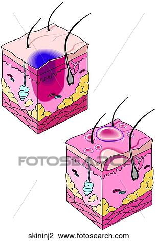 Skin Injuries 2 View Large Illustration Drawing - Skin Injuries 2. Fotosearch