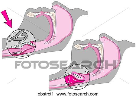 Clip Art - Types of Obstruction 1. Fotosearch