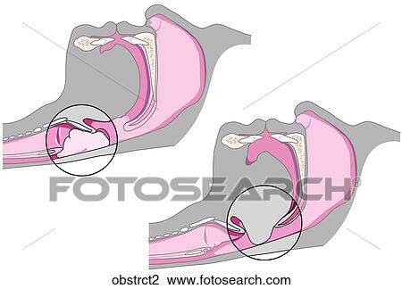 Types of Obstruction 2 View Large Illustration Drawing - Types of Obstruction 2. Fotosearch