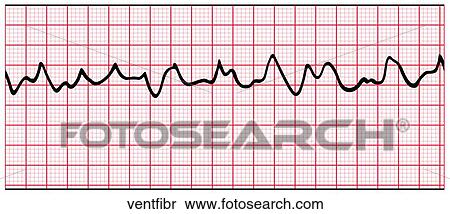 Stock Illustration - Ventricular Fibrillation. Fotosearch
