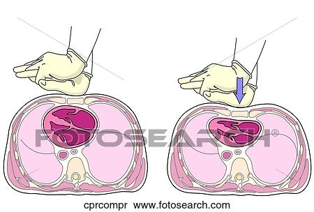 CPR Compressions View Large Illustration Stock Illustration - CPR Compressions. Fotosearch