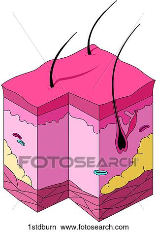 First Degree Burn View Large Illustration Stock Illustration - First Degree Burn. Fotosearch