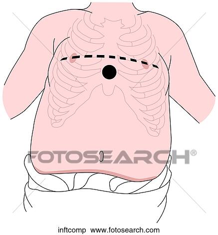 Infant Compression Site View Large Illustration Stock Illustration - Infant Compression Site. Fotosearch
