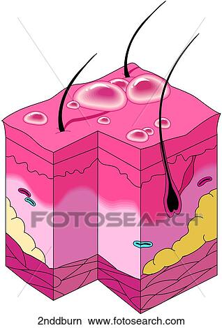 Second Degree Burn View Large Illustration Stock Illustration - Second Degree Burn. Fotosearch