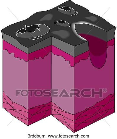 Third Degree Burn View Large Illustration Stock Illustration - Third Degree Burn. Fotosearch