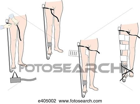 Application of Sager splint View Large Illustration Drawing - Application of Sager splint. Fotosearch