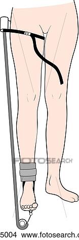 Application of Sager splint, step 2 View Large Illustration Stock Illustration - Application of Sager splint, step 2. Fotosearch