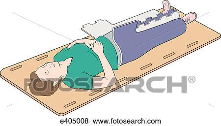 Application of the MAST, step 2 View Large Illustration Stock Illustration - Application of the MAST, step 2. Fotosearch