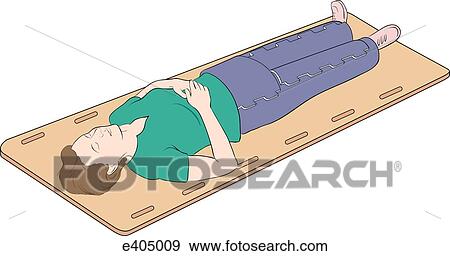 Application of the MAST, step 3 View Large Illustration Stock Illustration - Application of the MAST, step 3. Fotosearch