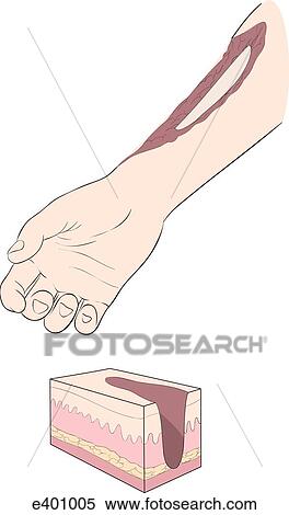 Burns, types (full-thickness) View Large Illustration Stock Illustration - Burns, types (full-thickness). Fotosearch