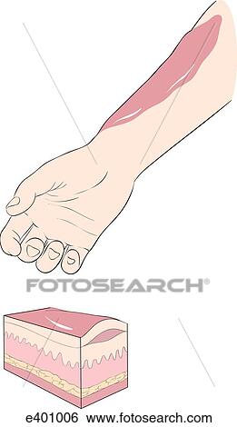 Burns, types (partial-thickness) View Large Illustration Stock Illustration - Burns, types (partial-thickness). Fotosearch