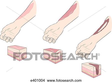 Burns, types View Large Illustration Stock Illustration - Burns, types. Fotosearch