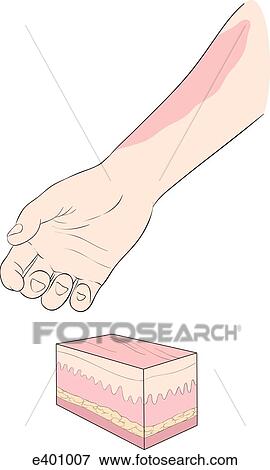 Burns, types (superficial) View Large Illustration Stock Illustration - Burns, types (superficial). Fotosearch