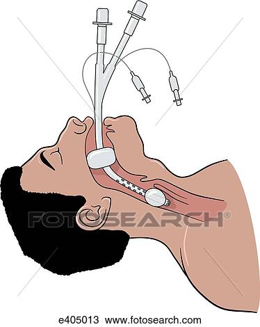 Combitude airway in place View Large Illustration Drawing - Combitude airway in place. Fotosearch