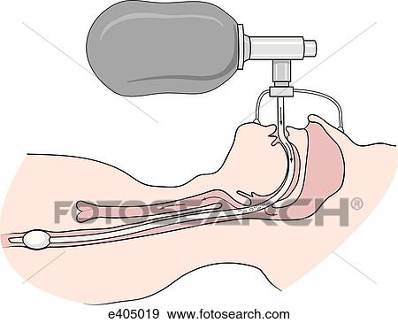 Eoa 位置 中に 食道 イラスト E Fotosearch