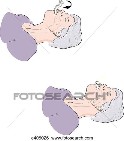 Stock Illustration - Insertion of oropharyngeal airway in adult. Fotosearch