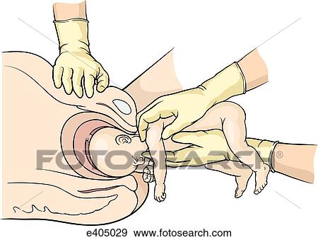 Stock Illustration - Mauriceau maneuver. Fotosearch