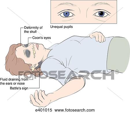 Stock Illustration - Signs of head injury. Fotosearch