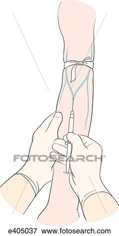Starting an intravenous infusion in an anterior cubital vein View Large Illustration Stock Illustration - Starting an intravenous infusion in an anterior cubital vein. Fotosearch