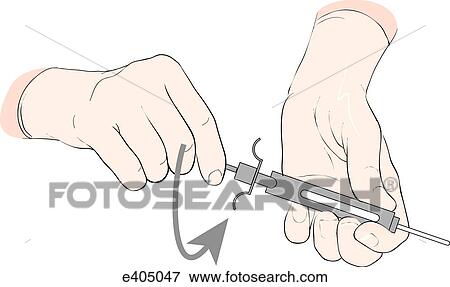 Stock Illustration - Tubex system, step 3. Fotosearch