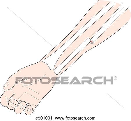 Closed fracture of the radius. View Large Illustration Clip Art - Closed fracture of the radius.. Fotosearch