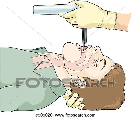 Clipart - Head is extended at the atlanto-occipital joint and neck is flexed. A small towel is placed beneath the head for difficult cases. Laryngoscope is then entered into the oral cavity.. Fotosearch