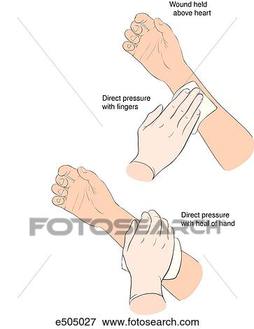 Illustration showing two ways of manually controlling bleeding. (top) Applying direct pressure on the wound with the fingers. (bottom) Applying direct pressure with the heel of the hand. View Large Illustration Stock Illustration - Illustration showing two ways of manually controlling bleeding. (top) Applying direct pressure on the wound with the fingers. (bottom) Applying direct pressure with the heel of the hand.. Fotosearch
