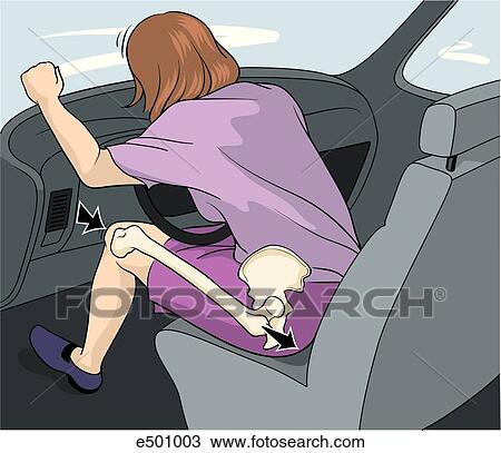 Drawing - Illustration shows how a hip dislocation injury can result from an auto injury that applies force to the patella.. Fotosearch
