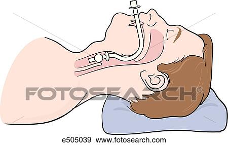 Stock Illustration - Image shows how, when properly positioned, the cuff of the endotracheal tube should be just below the vocal cords.. Fotosearch